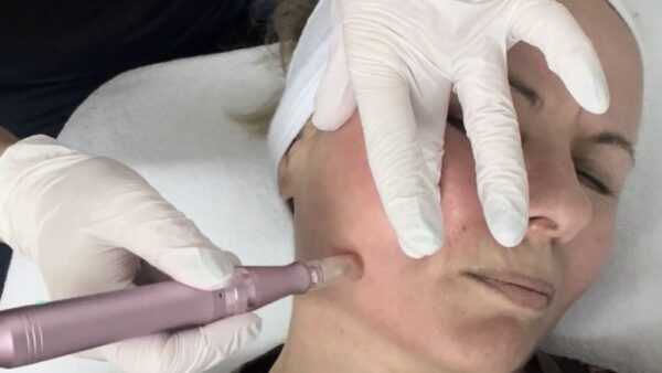 Microneedling